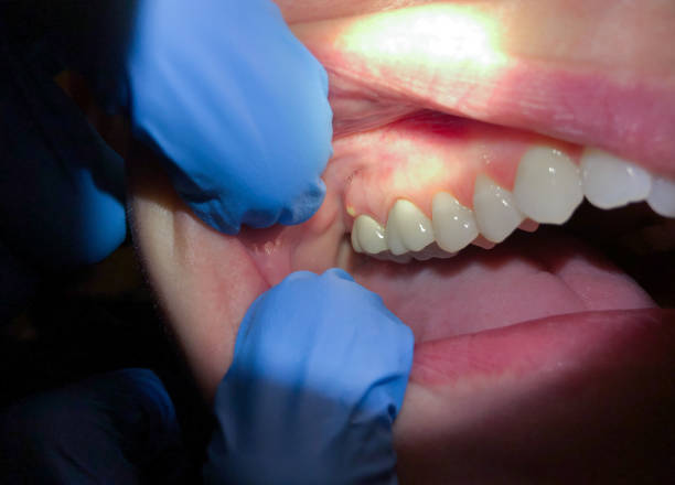 Best Urgent Dental Care for Toothache in Albion, IN